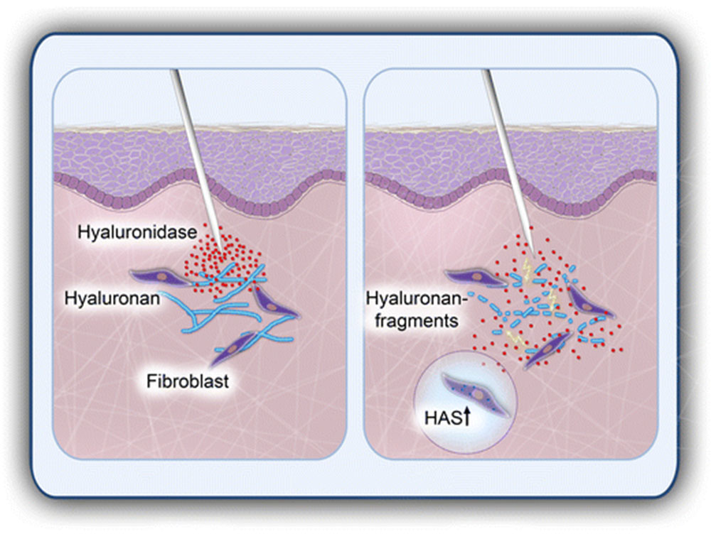 hyaluronidase injection