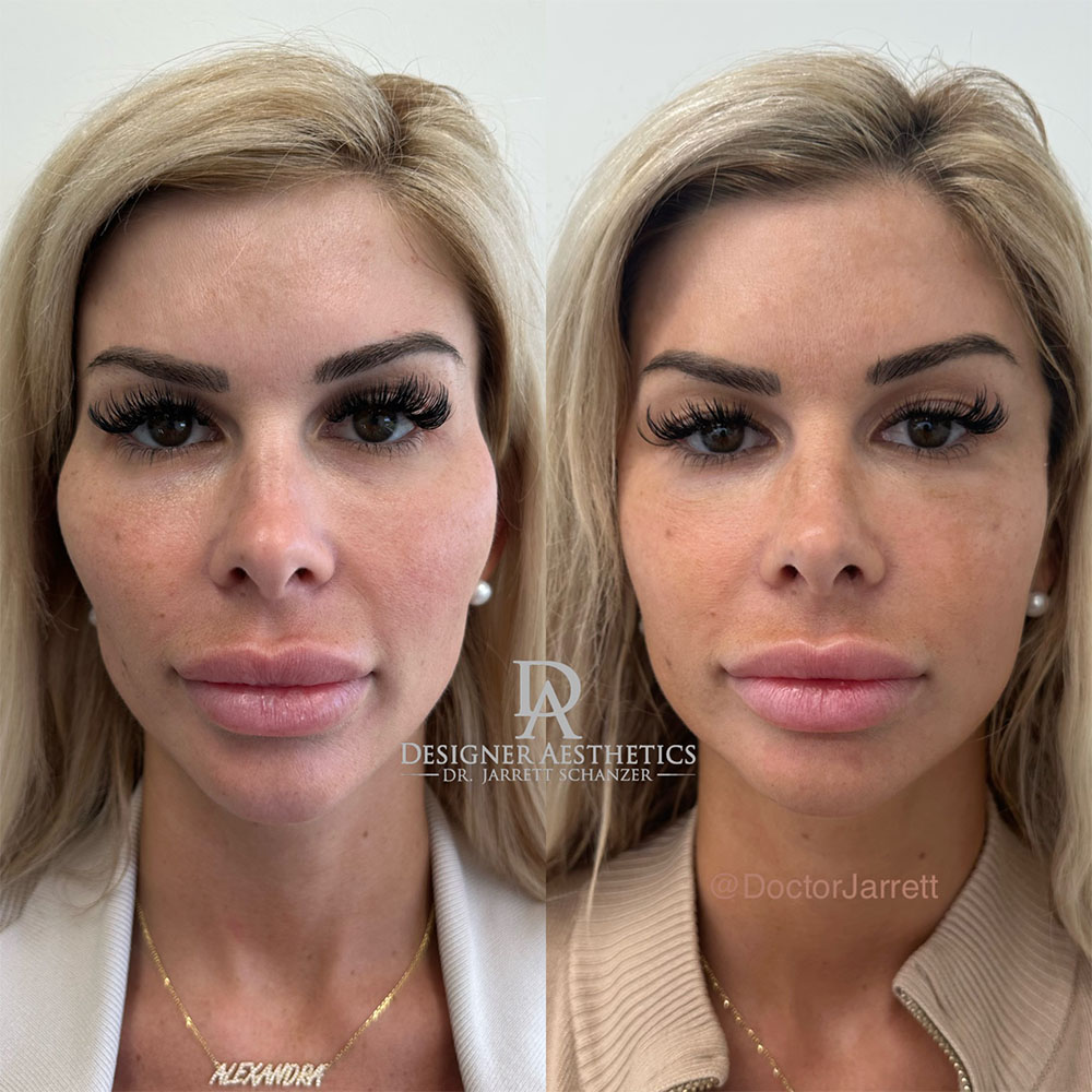 hyaluronidase dissolving facial filler