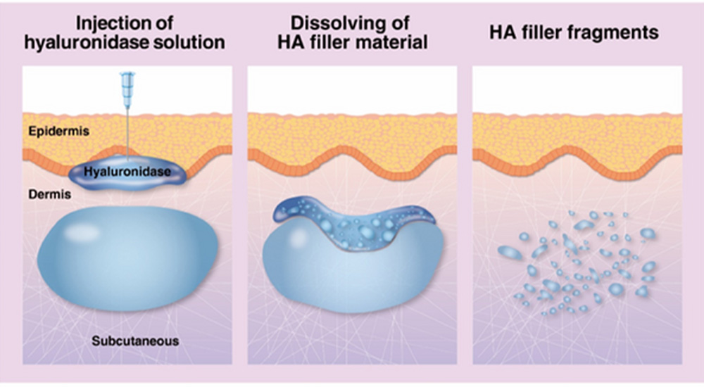 hyaluronidase injection dissolving ha filler