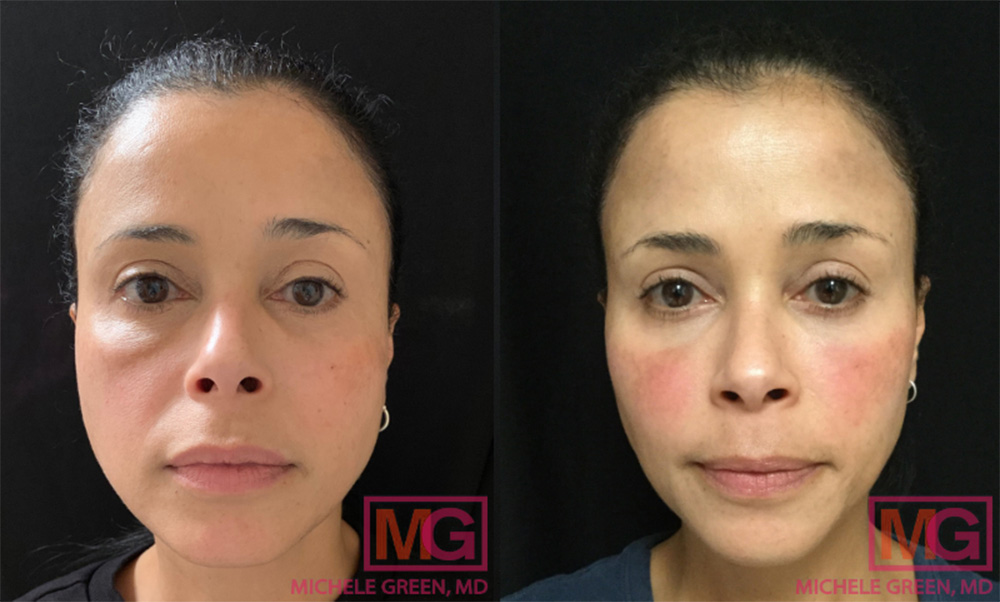 hyaluronidase usage on face