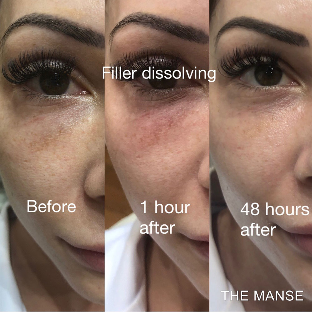 dissolving filler before and after