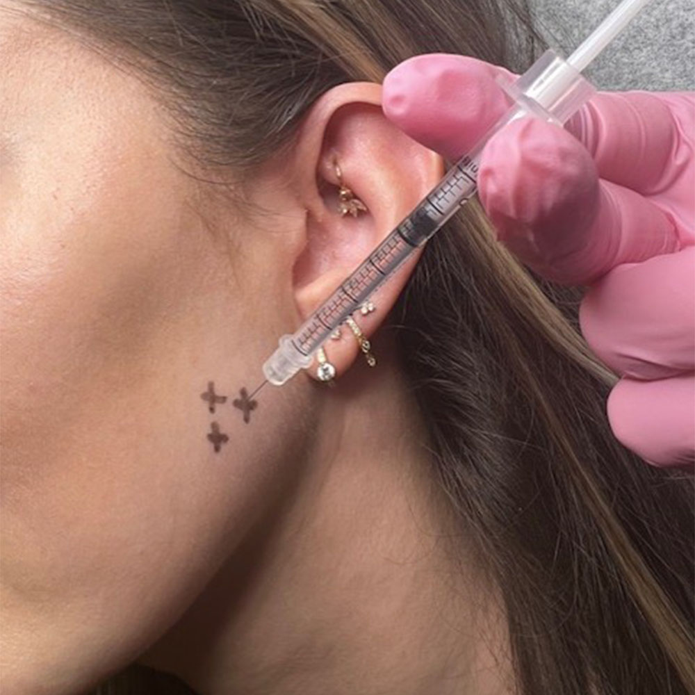 masseter botox injection