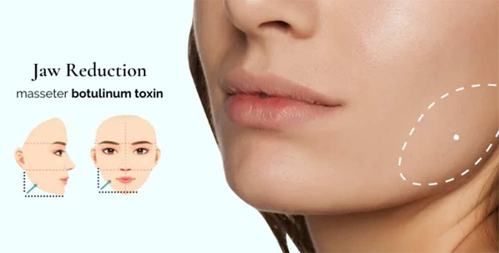 masseter botox