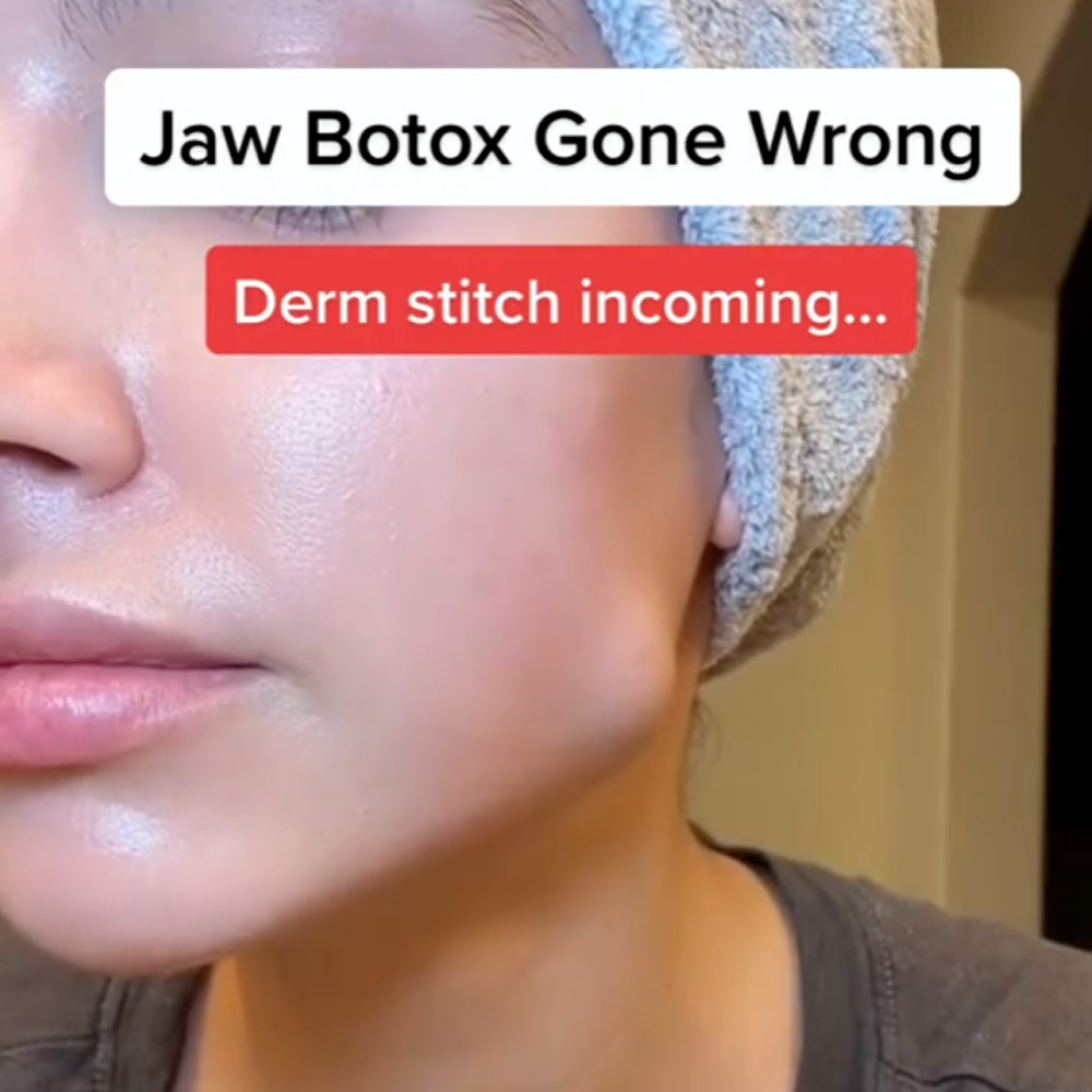masseter botox gone wrong