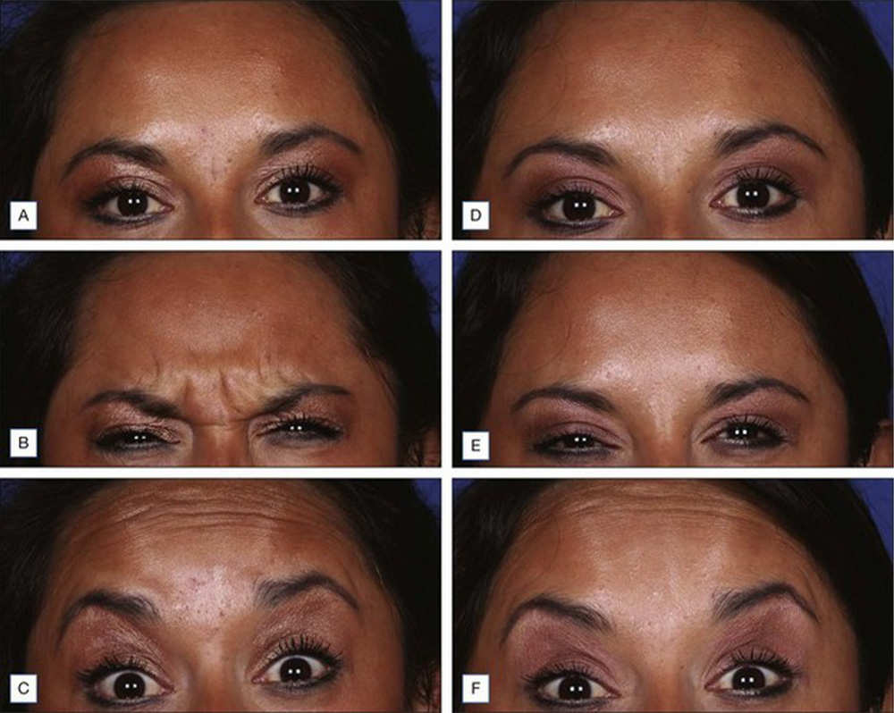 Glabella Botox