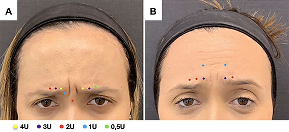 Glabella Botox injection points