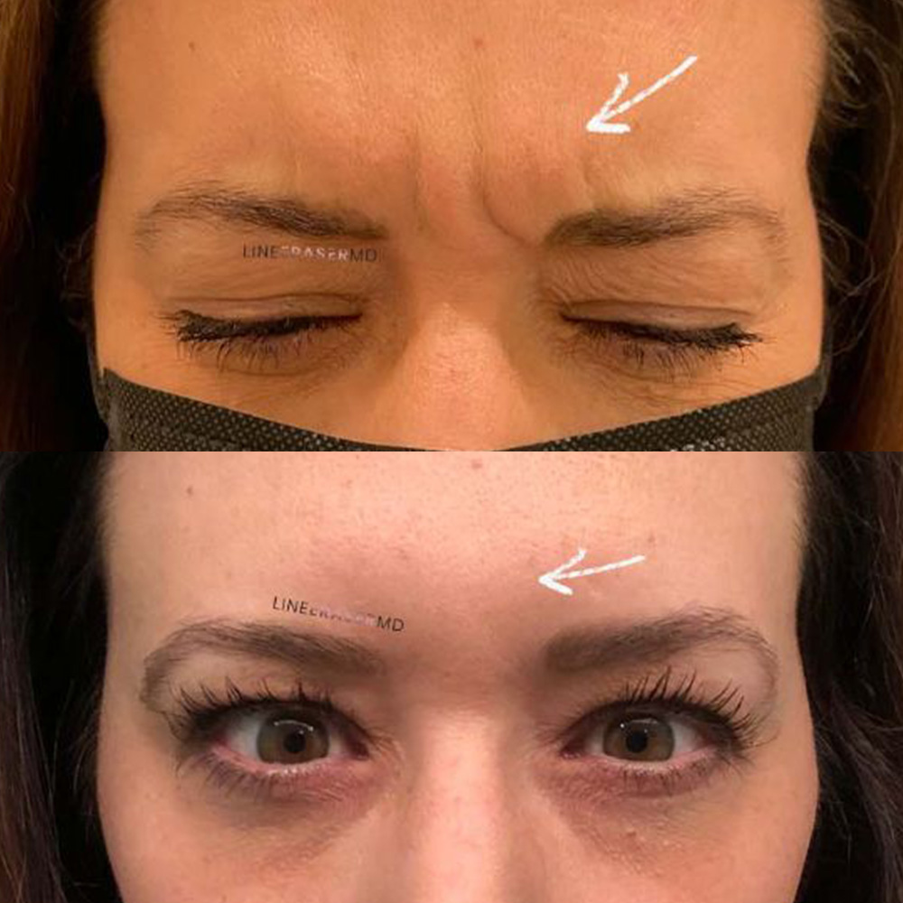 Glabella Botox
