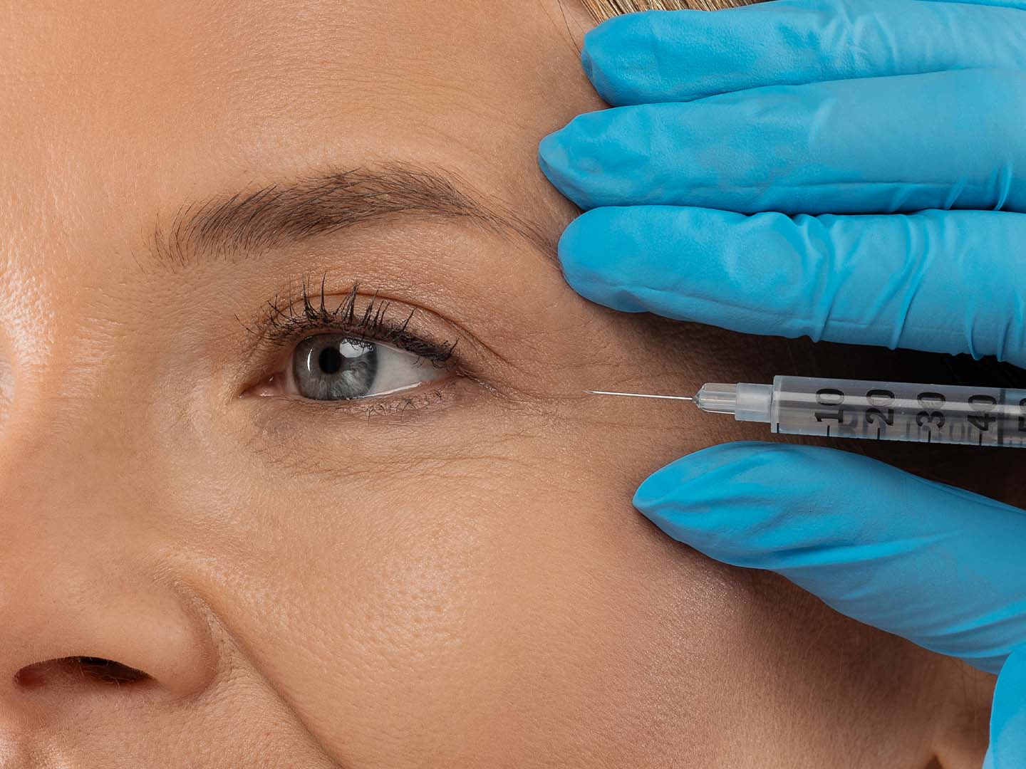 Botox for Crow’s Feet: How It Works and What to Expect