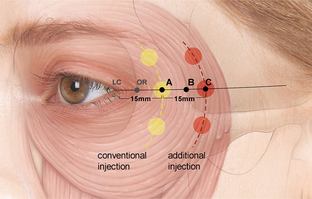 botox for crows feet