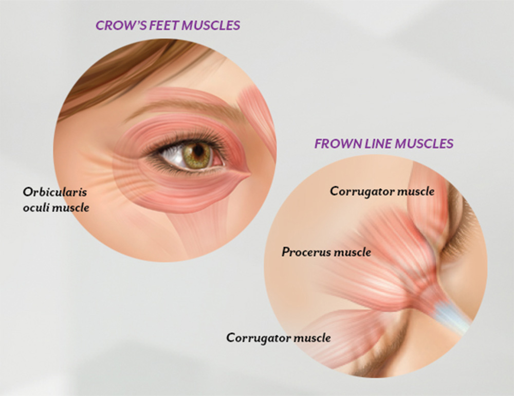 botox for crows feet