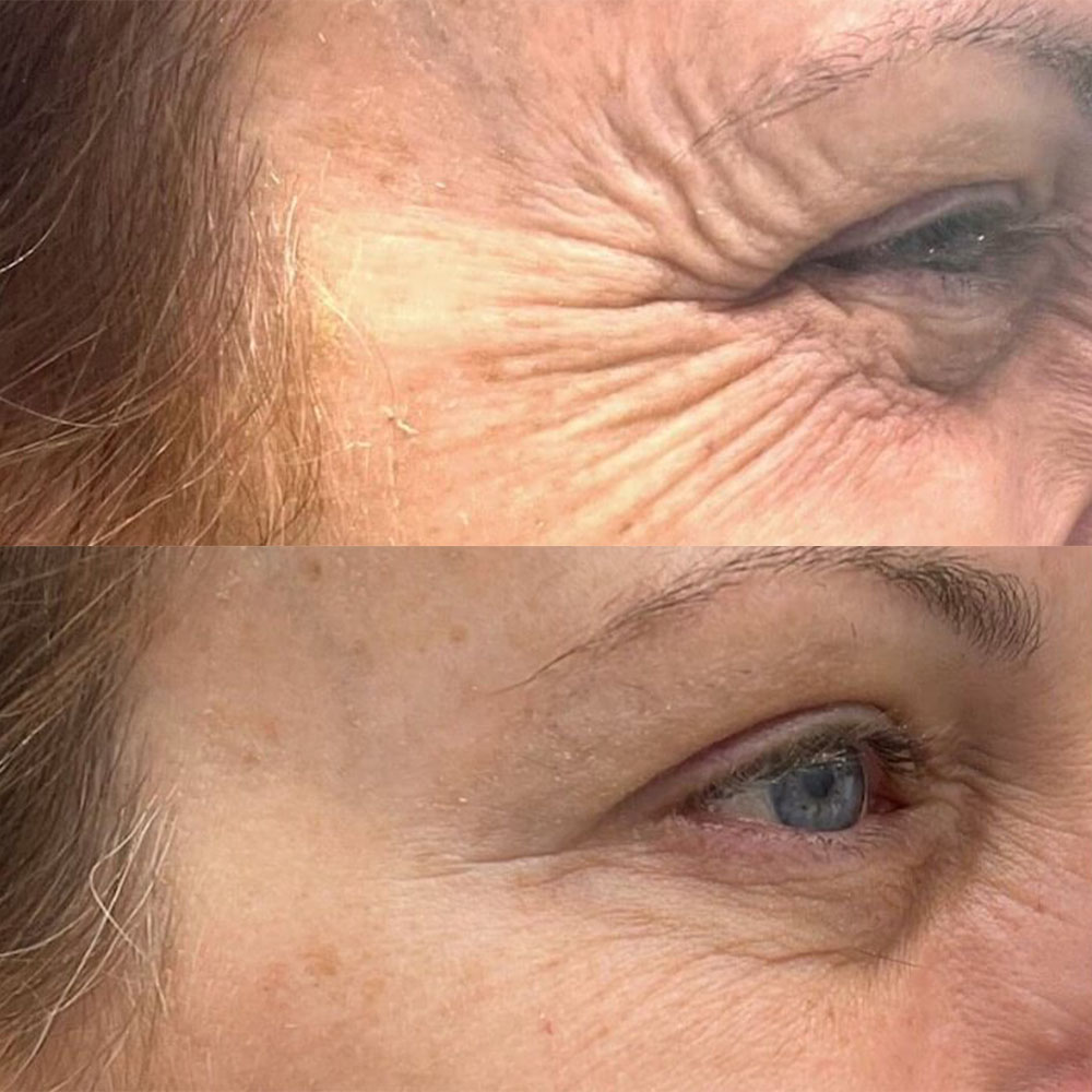 botox for crows feet results