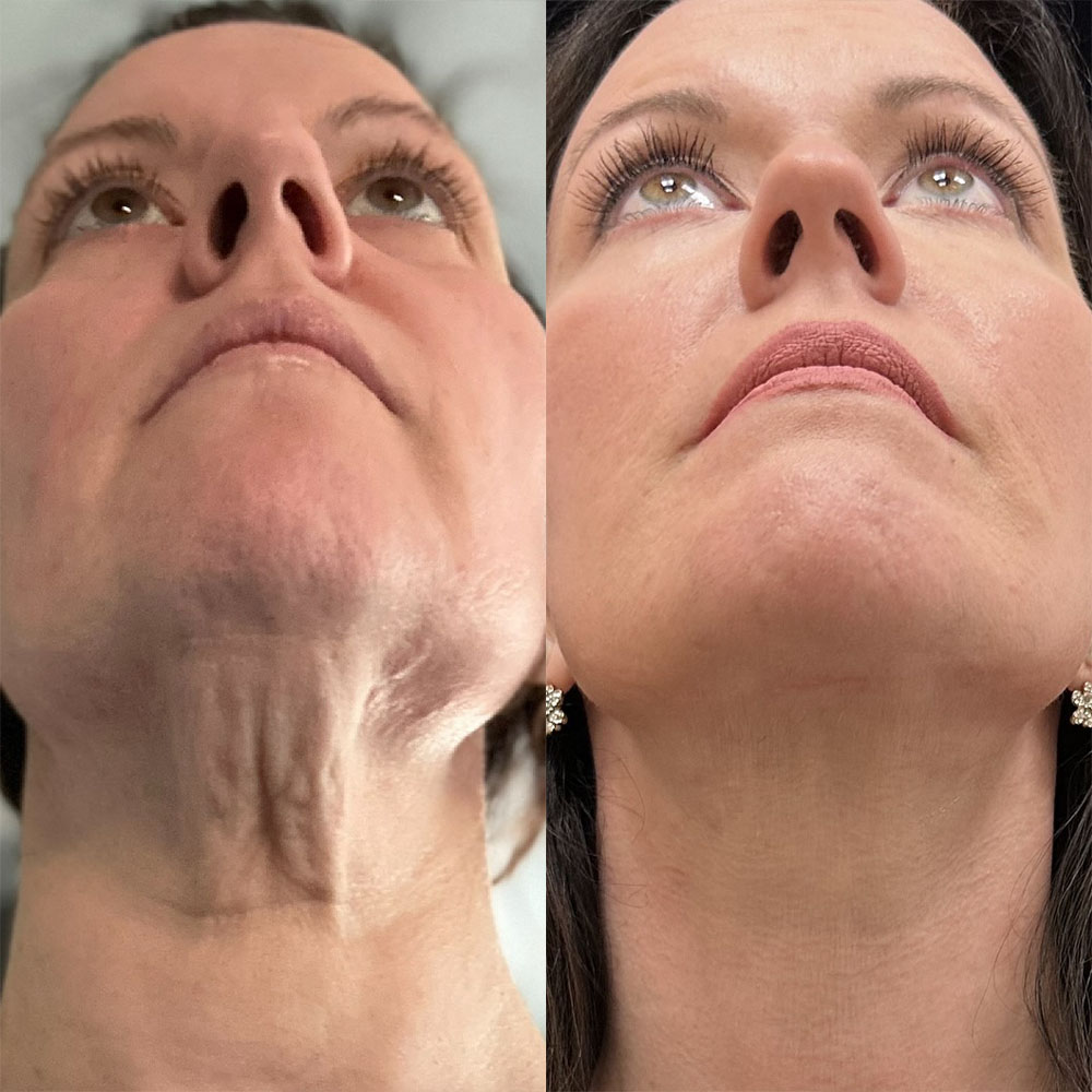 How to Treat Ozempic Face