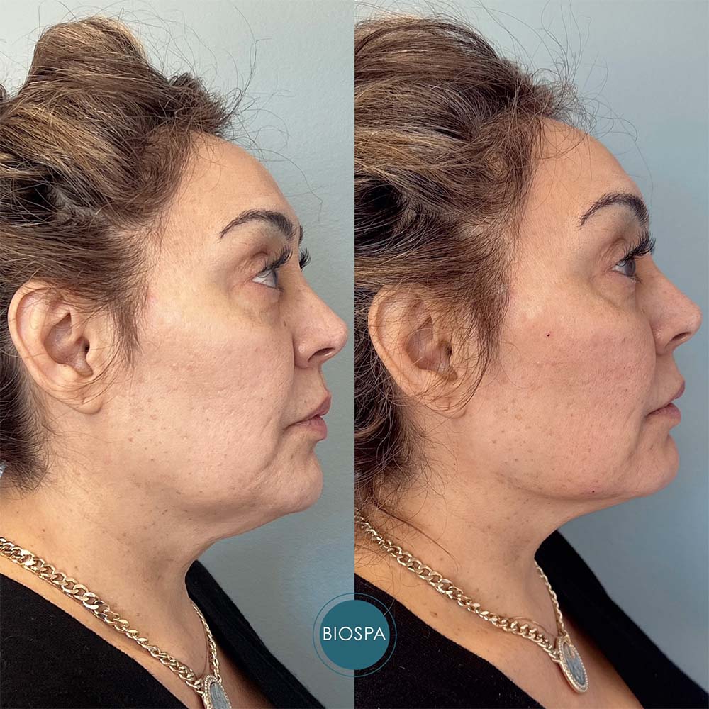 How to Treat Ozempic Face