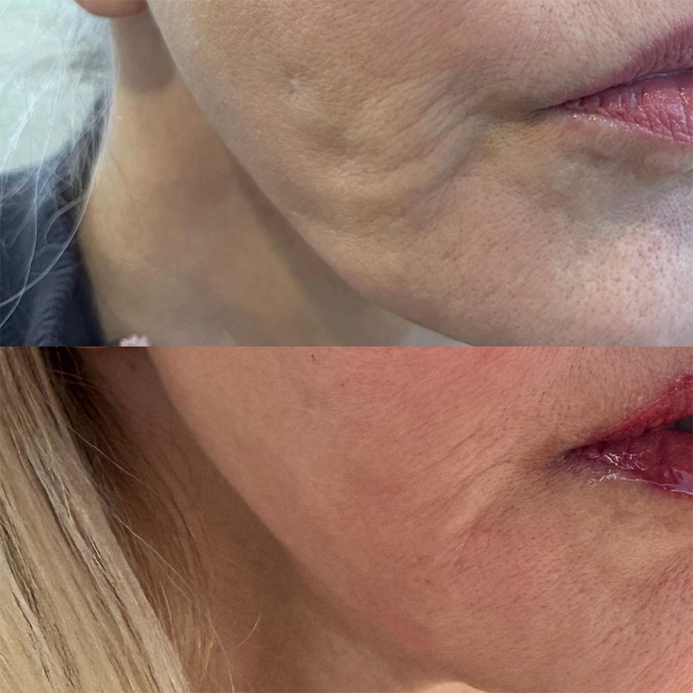 How to Treat Ozempic Face