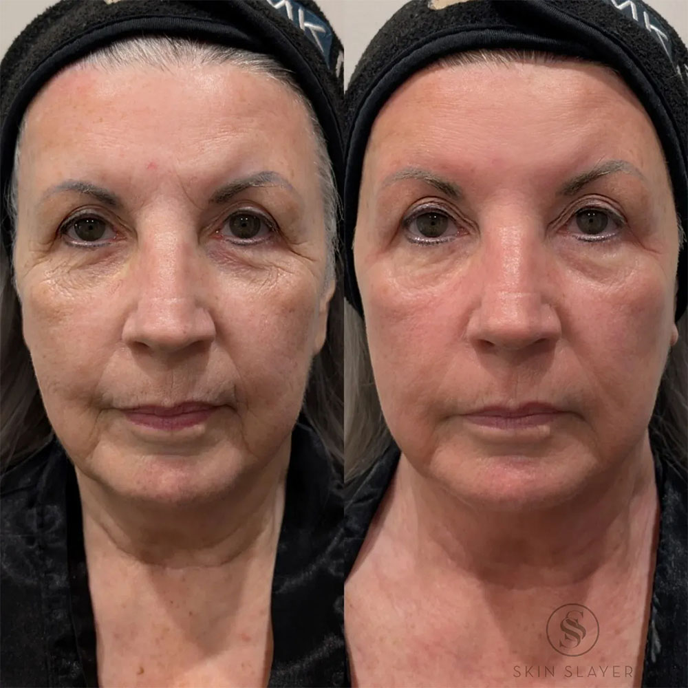 exosomes vs stem cells