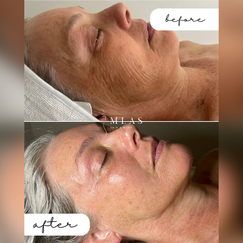 exosomes vs stem cells