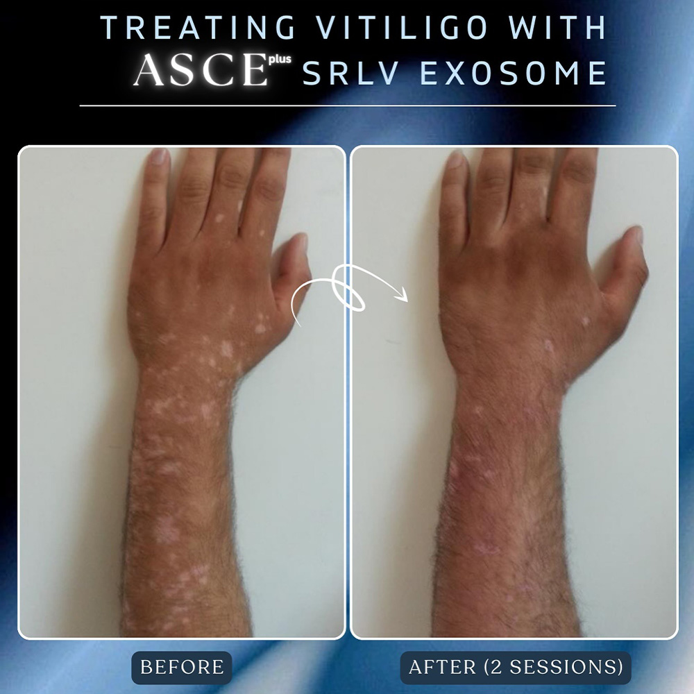 exosomes vs stem cells