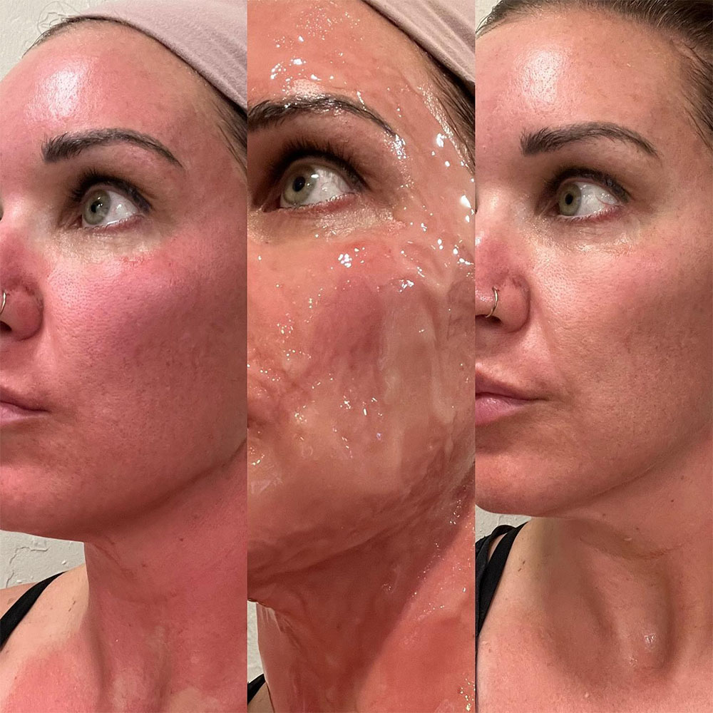 exosomes treatment for face