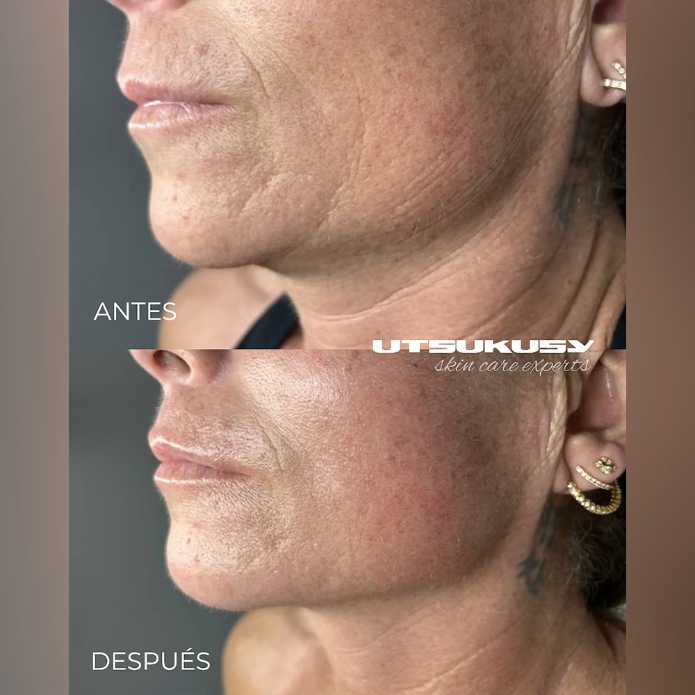 exosomes treatment for face