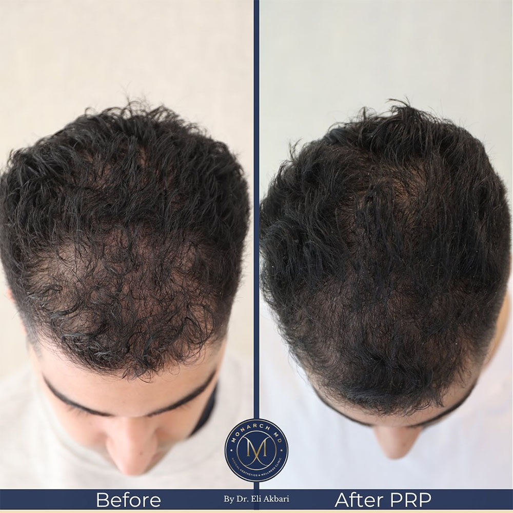 microneedling for hair loss