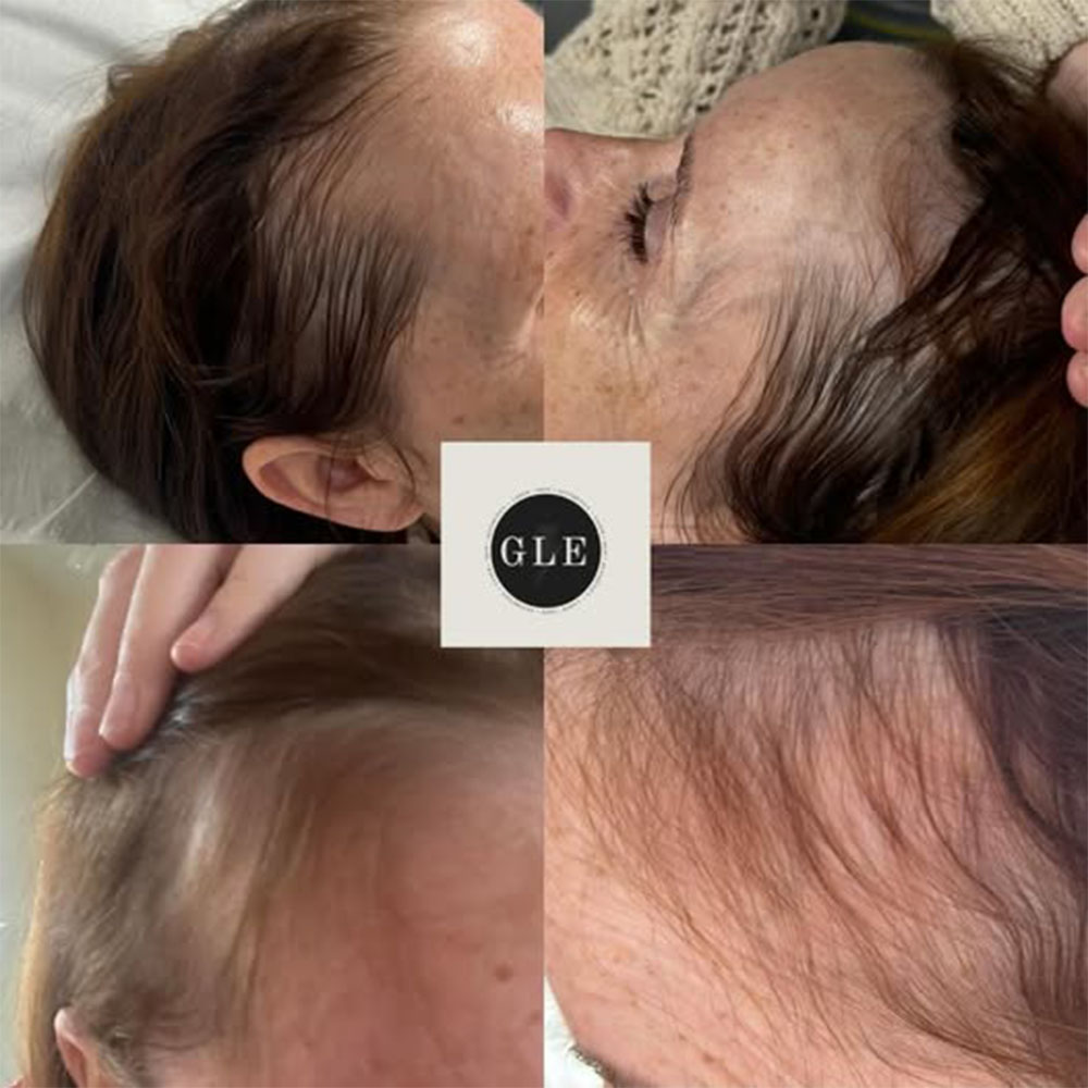 polynucleotides hair loss