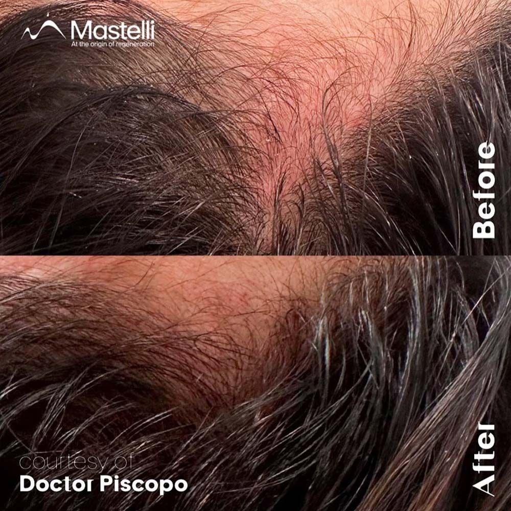 polynucleotides hair loss