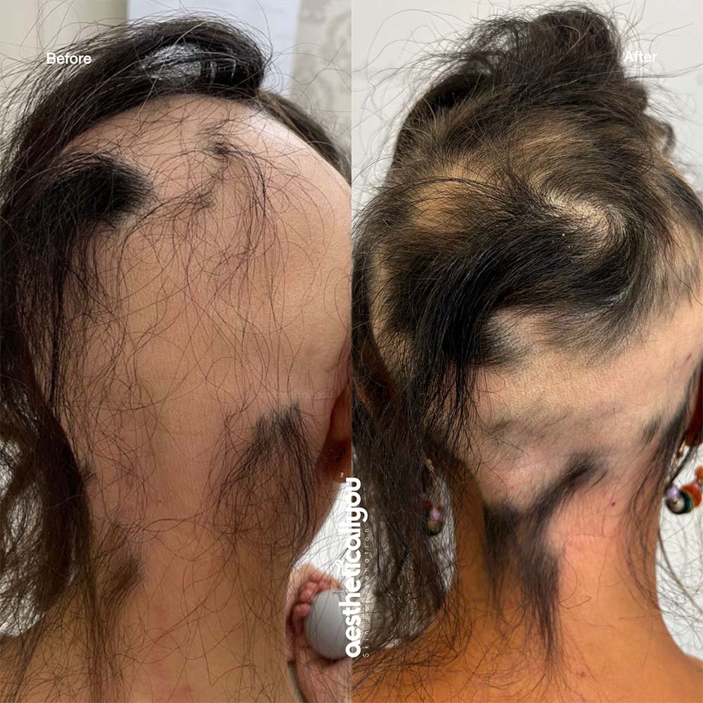 prp for hair loss