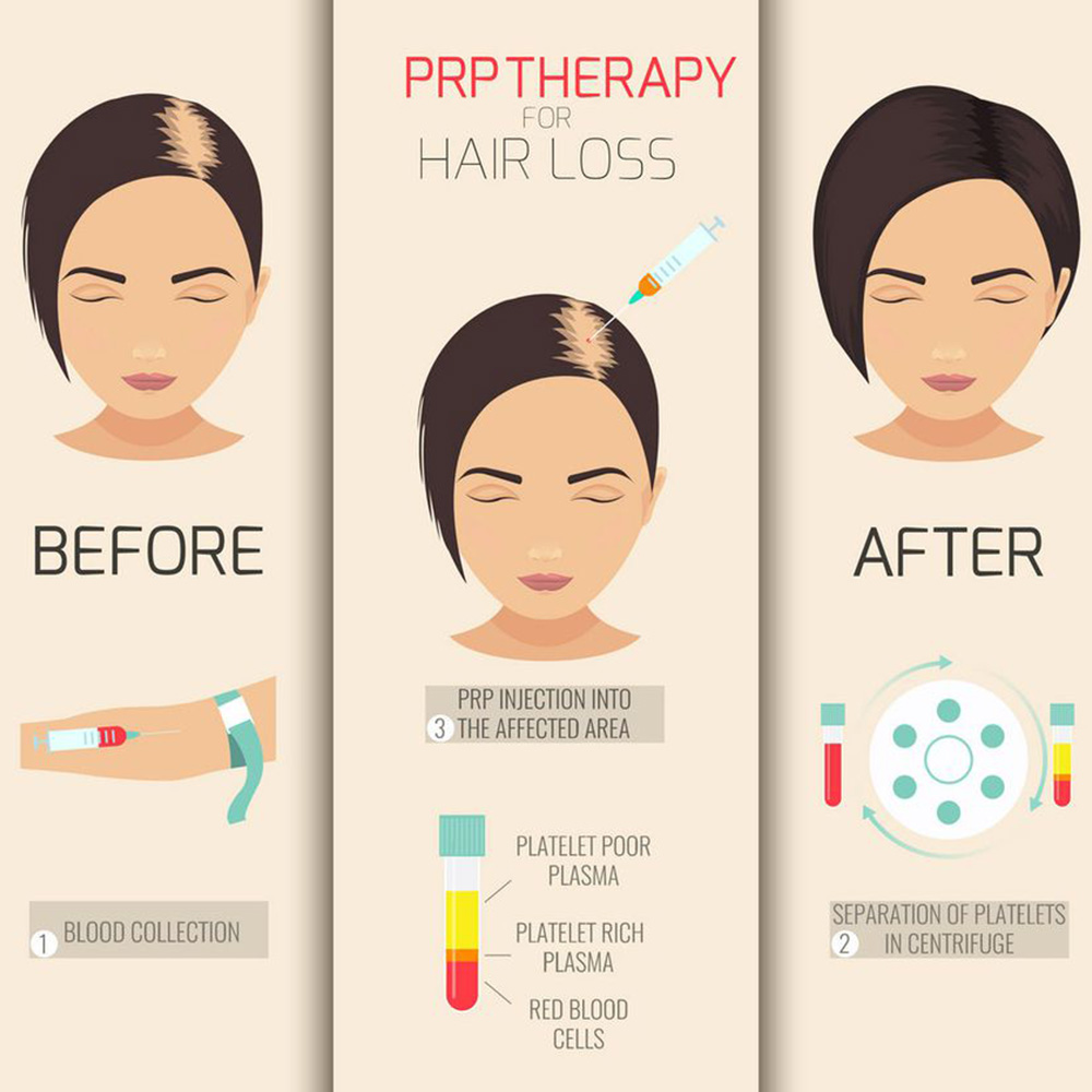 prp for hair loss