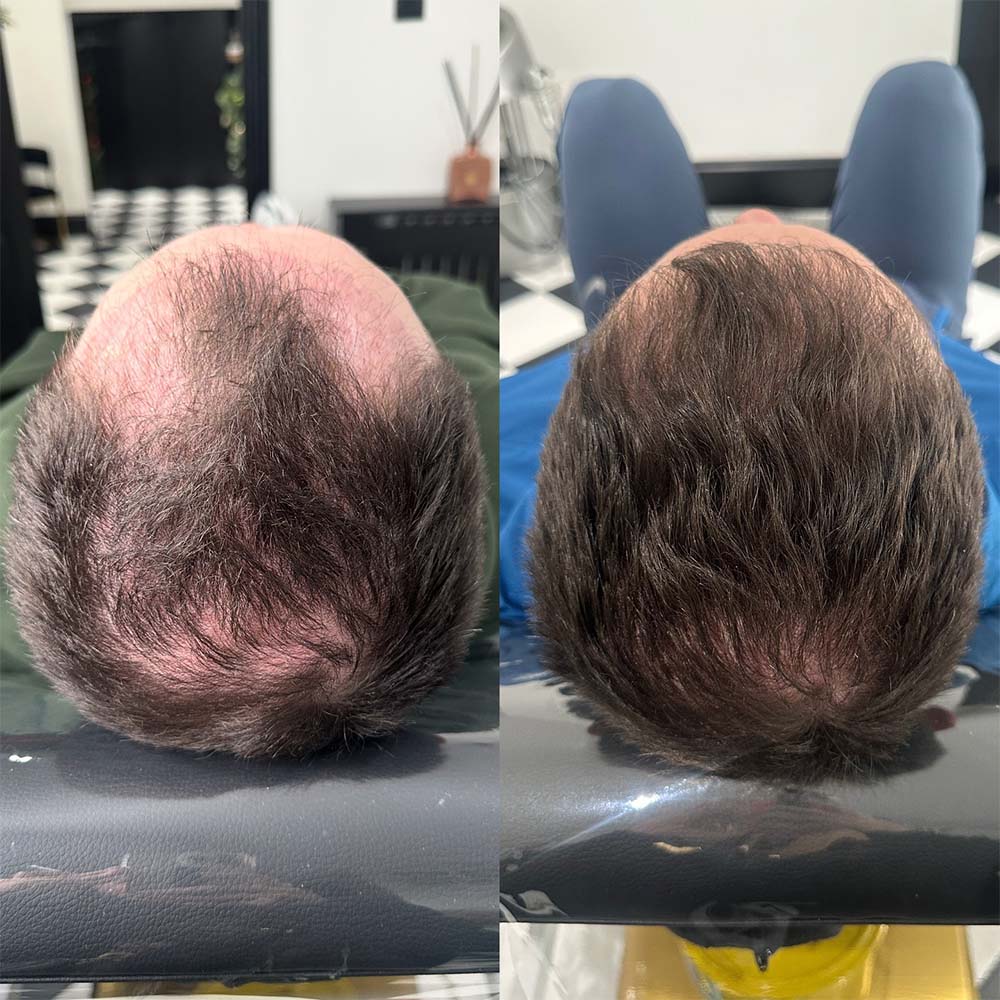 exosomes for hair loss