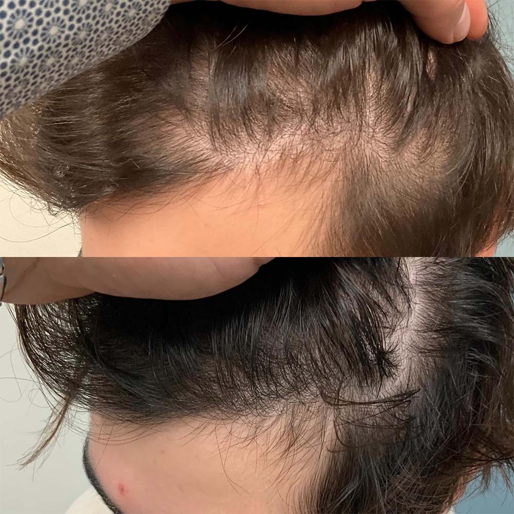 exosomes for hair loss