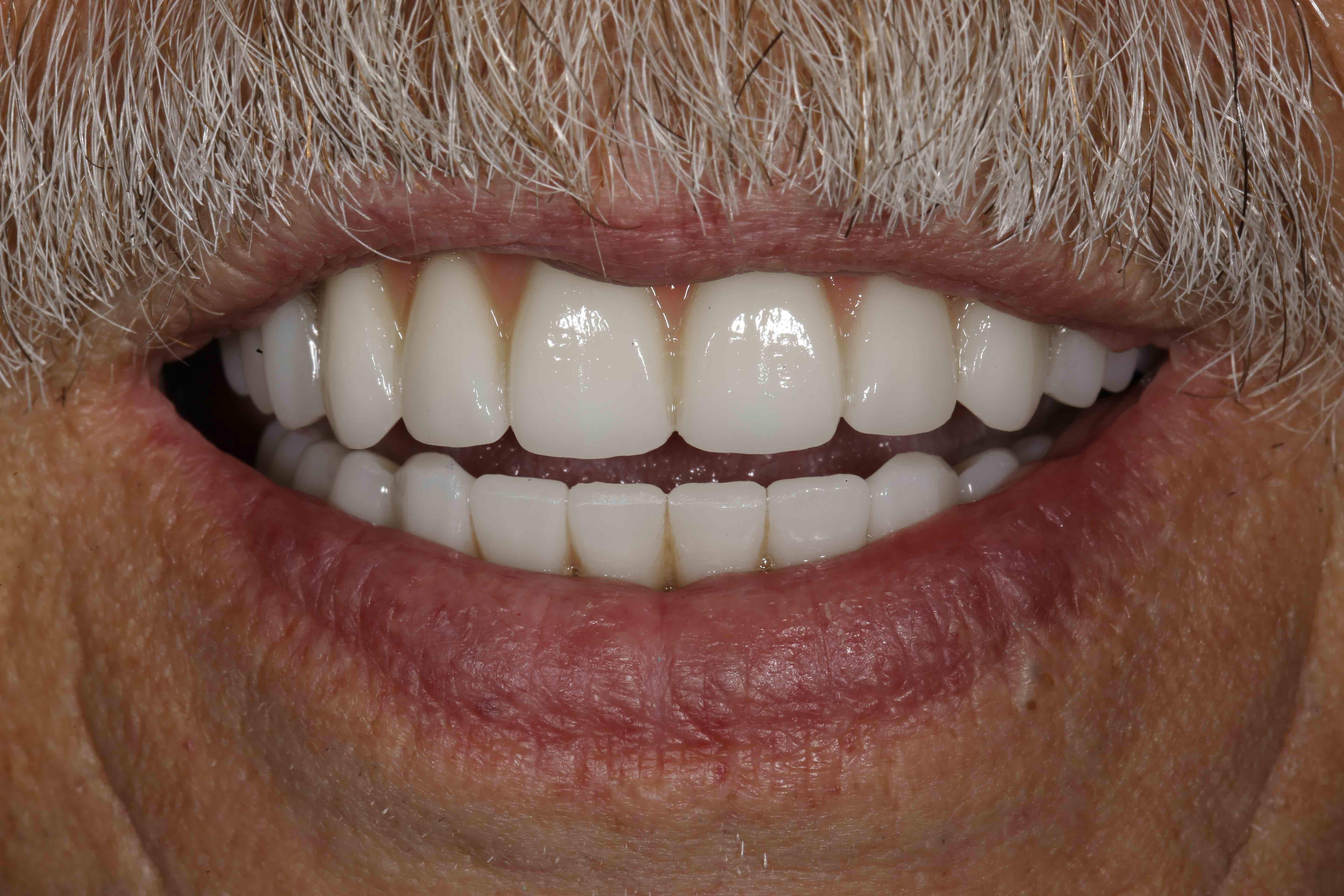 Close-up of an older man's mouth, showing white, even teeth and a mustache—highlighting the positive results of regular dentist visits.