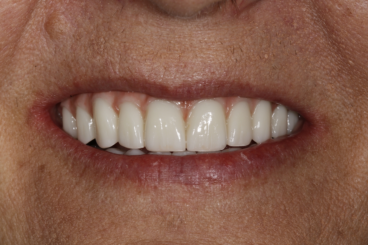 Close-up of a person's mouth showing clean, straight, white teeth and healthy gums, reflecting the expert care of a dentist. The lips are slightly parted in a smile.