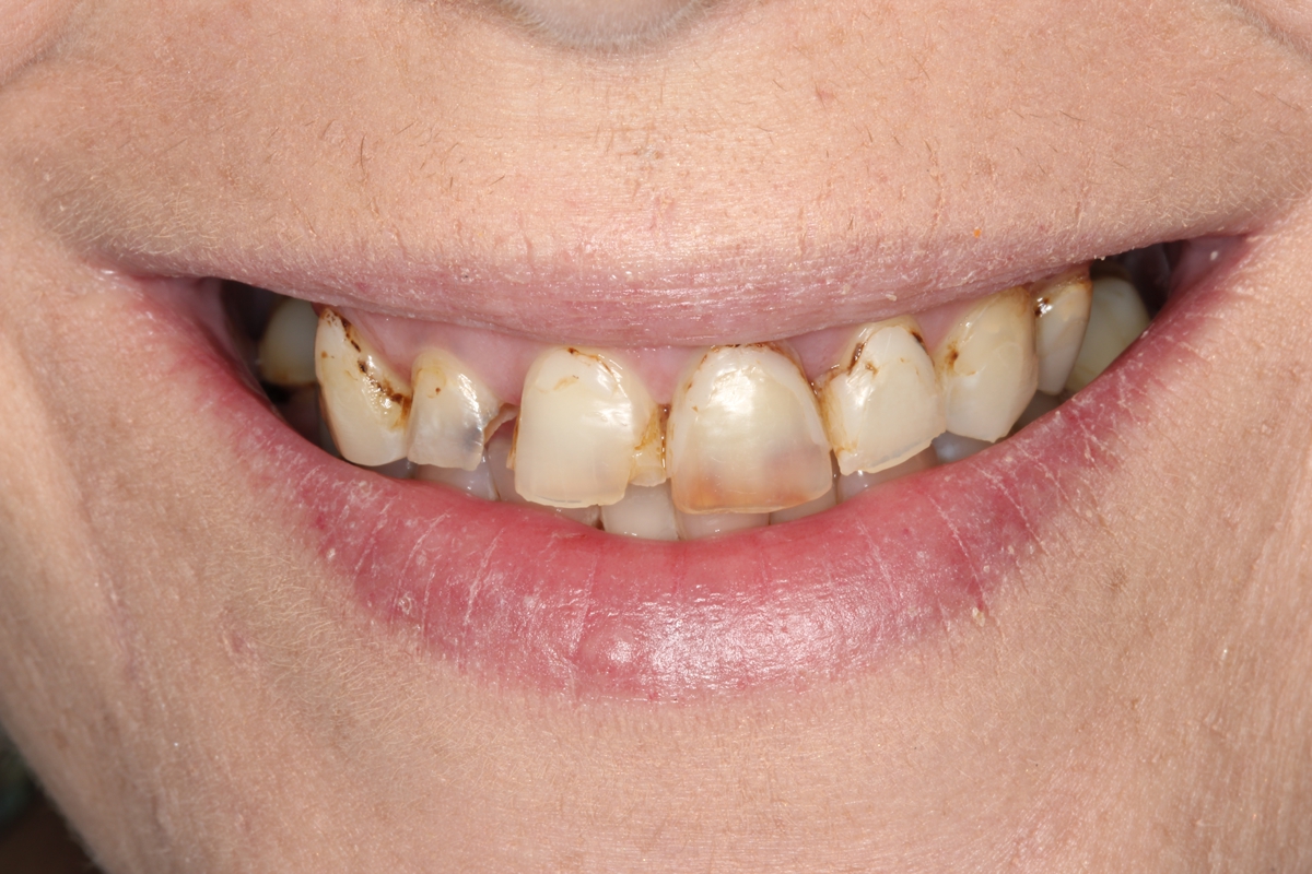 Close-up of a smiling mouth showing teeth with visible brown stains, discoloration, and plaque buildup—signs that a visit to the dentist may be needed.