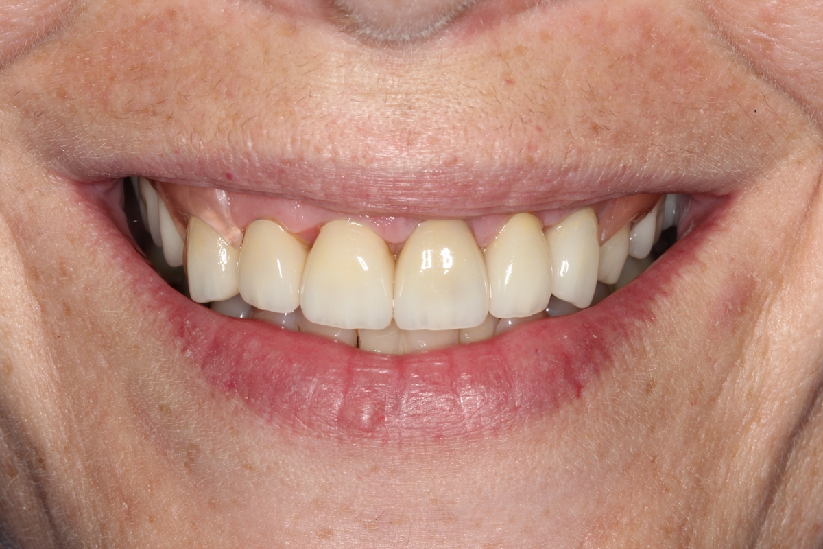Close-up of a person's smile showing upper front teeth with visible discoloration and gaps, highlighting issues a dentist can address.