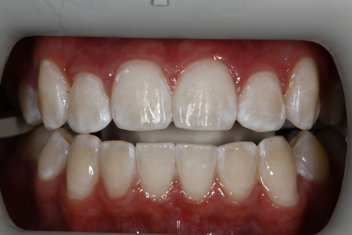 Close-up of a person's upper and lower front teeth and gums with a dental retractor holding the mouth open during a dentist examination.