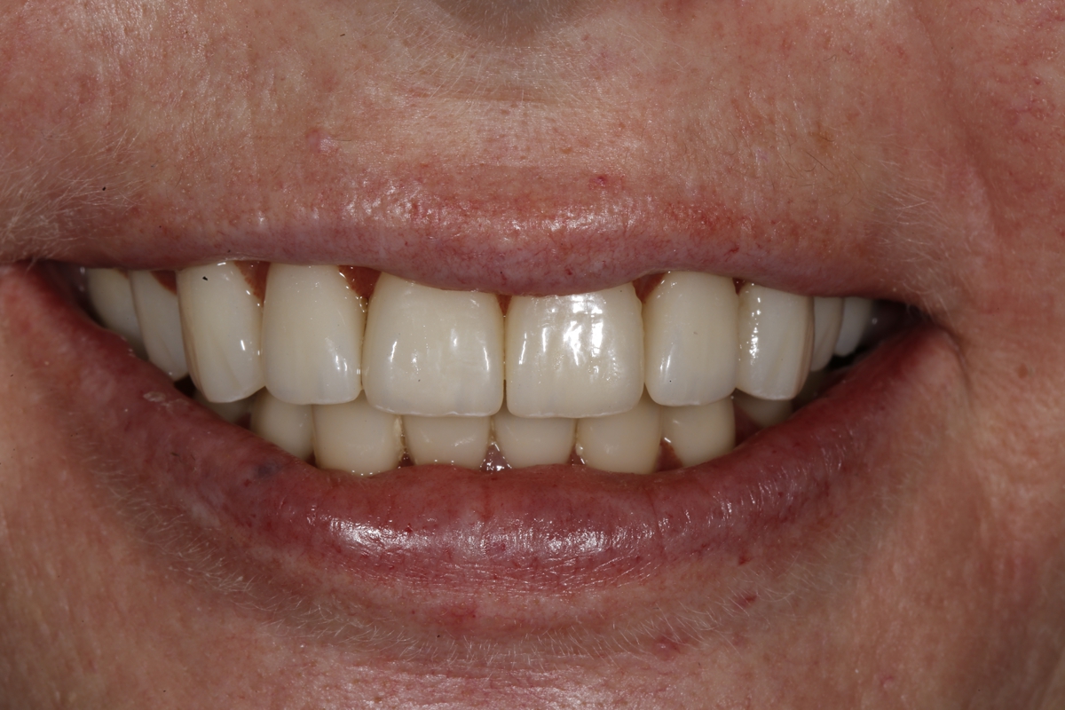 Close-up of a person's mouth showing a smile with clean, straight, and well-aligned teeth, reflecting the care of a professional dentist.