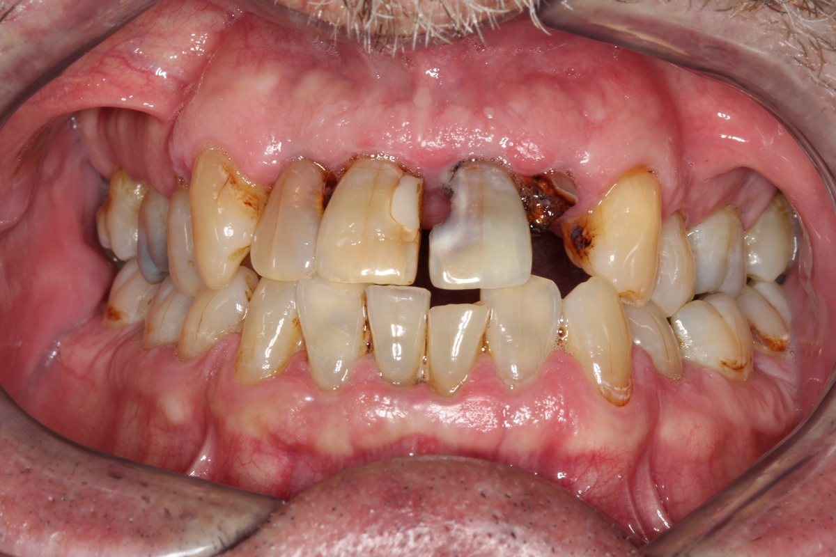 Close-up of an open mouth revealing severely decayed, discolored, and misaligned teeth with visible gum inflammation, highlighting the urgent need for dentist intervention.