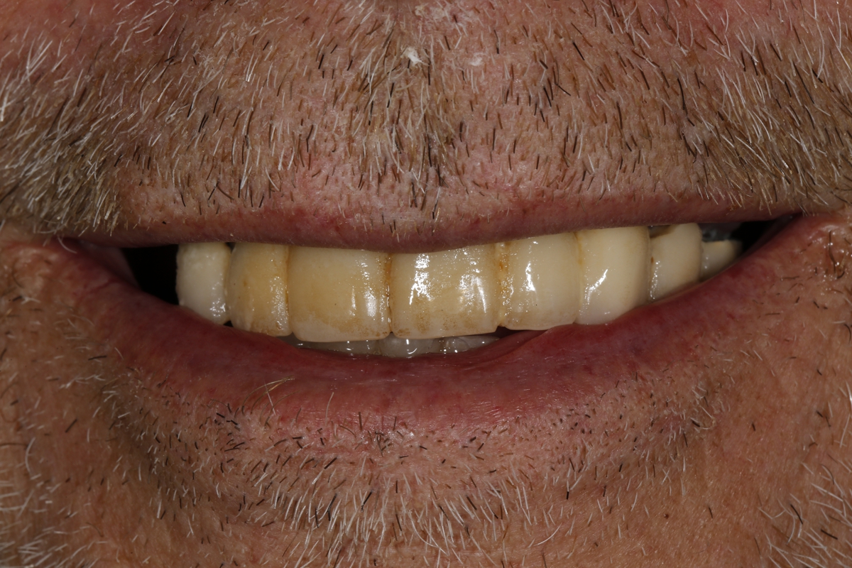 Close-up of a man's mouth showing discolored teeth with visible staining and facial hair, highlighting the need for a visit to the dentist.