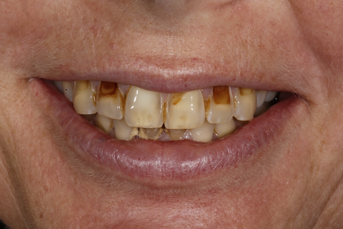 Close-up of a person's mouth showing stained and discolored upper and lower teeth, highlighting the need for a dentist's professional care.