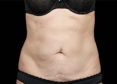 Before Emsculpt NEO