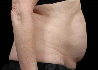 Before Emsculpt NEO