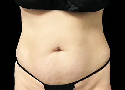 After Emsculpt NEO