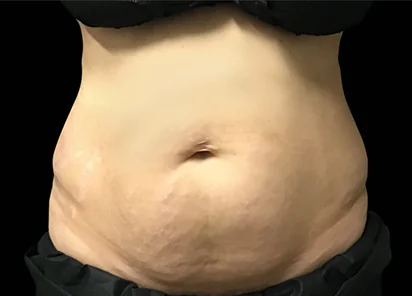Before Emsculpt NEO