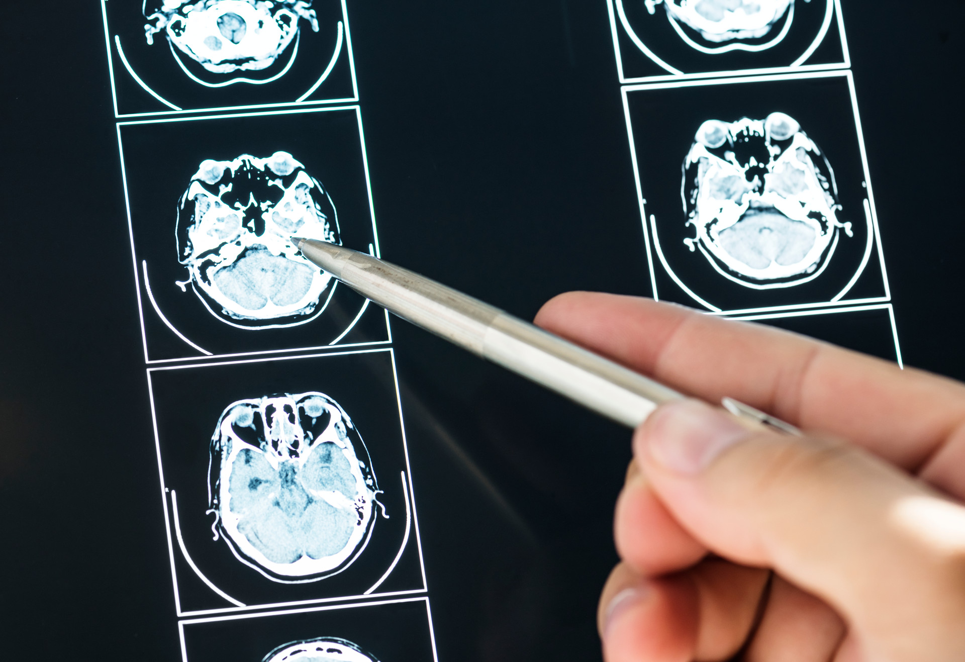 Understanding Neurological Disorders: Signs, Symptoms, Causes, & What to Do