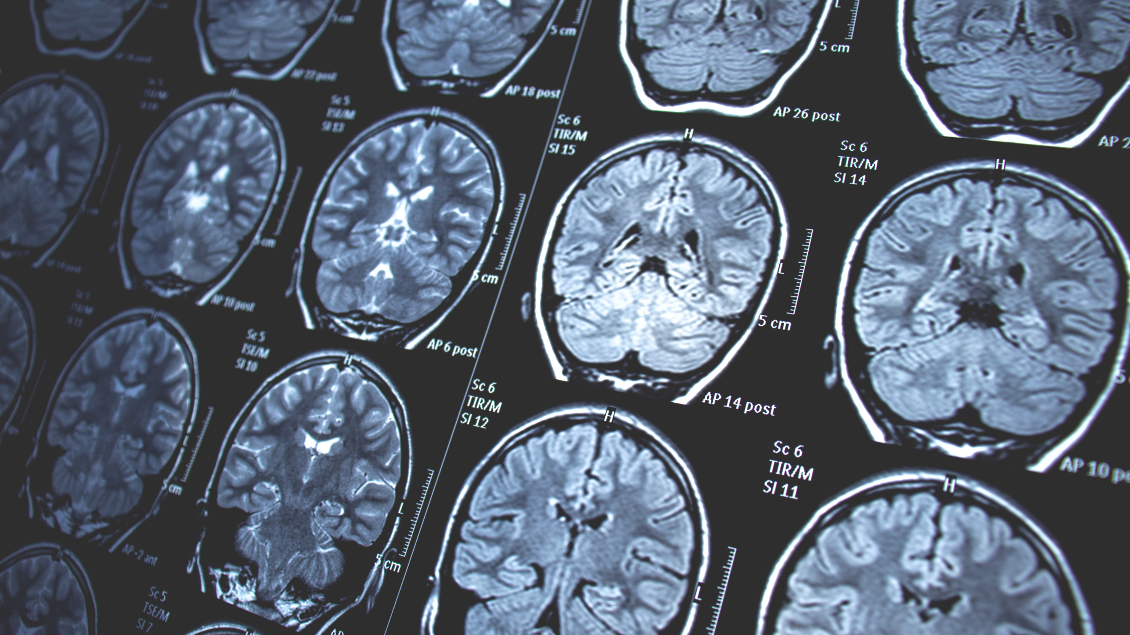 Dr. Justin Dearing reviews quantitative EEG brain mapping data at The Dearing Clinic in Brentwood, Tennessee — a functional neurology assessment tool used to evaluate brain performance, network coordination, and neurological dysfunction in patients with brain fog, post-concussion syndrome, chronic fatigue, POTS, and long COVID.