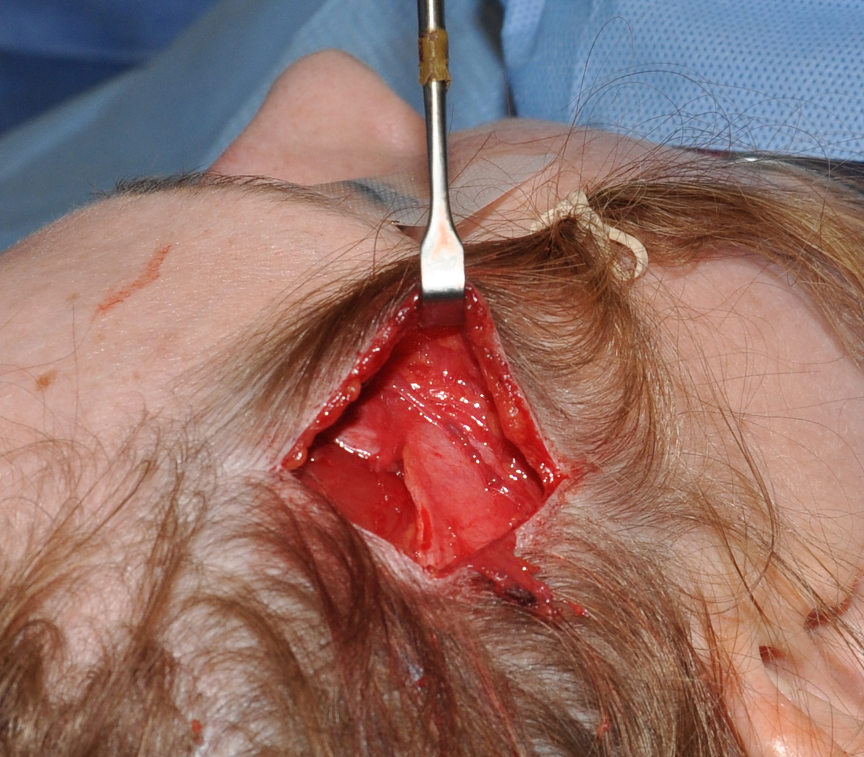 migriane surgery