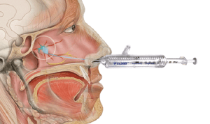 Sphenopalatine ganglion block with Tx360 device