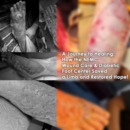 A Journey to Healing: How the NEMC Wound Care & Diabetic Foot Center Saved a Limb and Restored Hope!