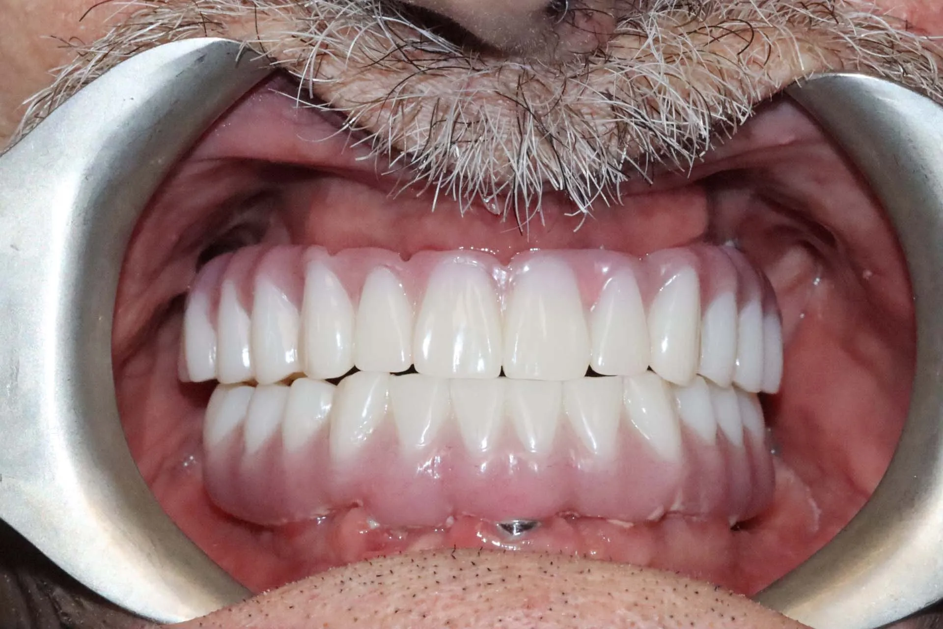 Digital Cosmetic Smile Makeover