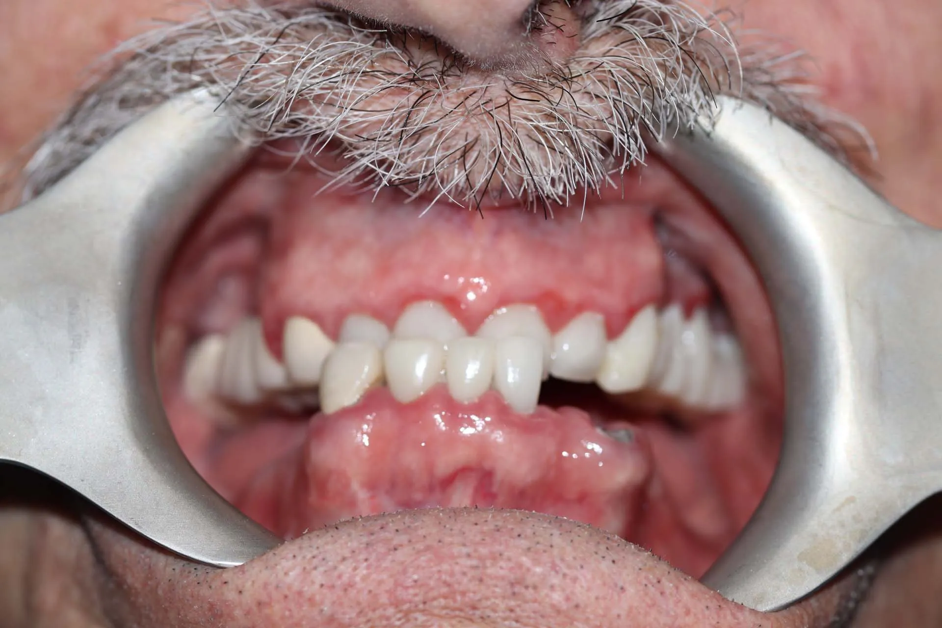 Digital Cosmetic Smile Makeover